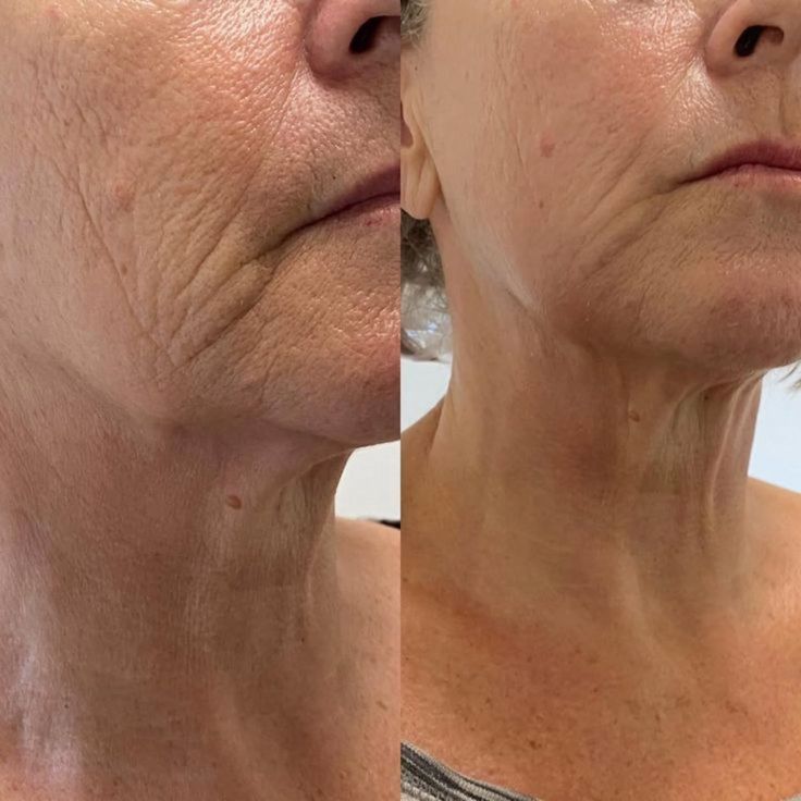 Crio Full Face sem agulhas — Dra. Fernanda Rabelo