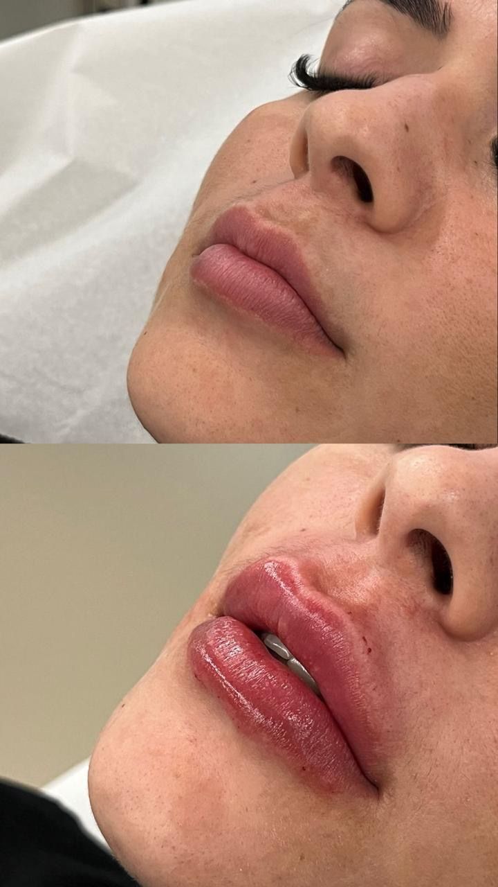 Preenchimento labial — Dra. Fernanda Rabelo