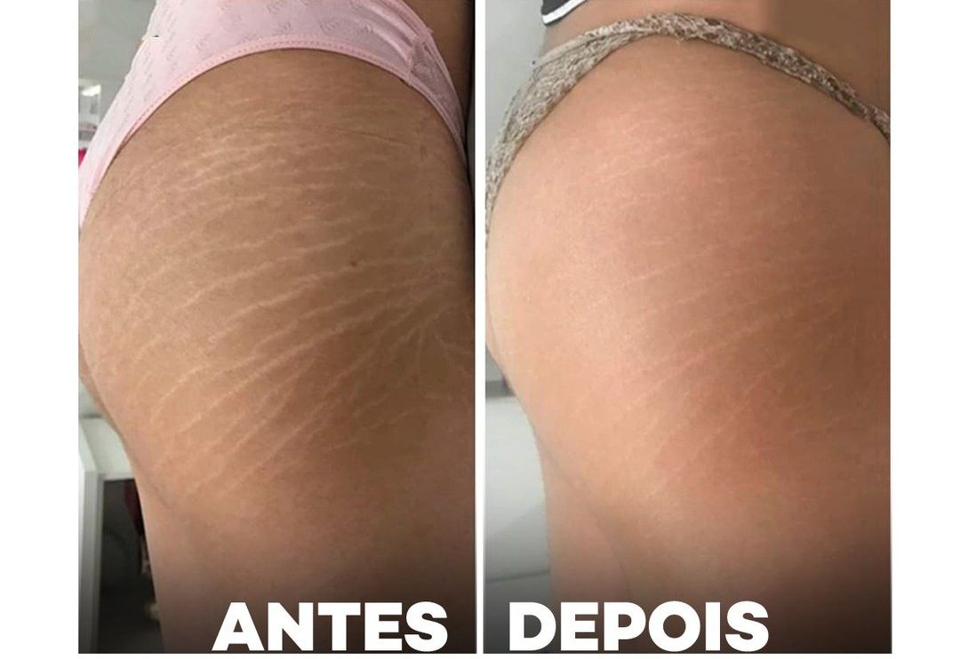 Tratamento de estrias — Dra. Fernanda Rabelo