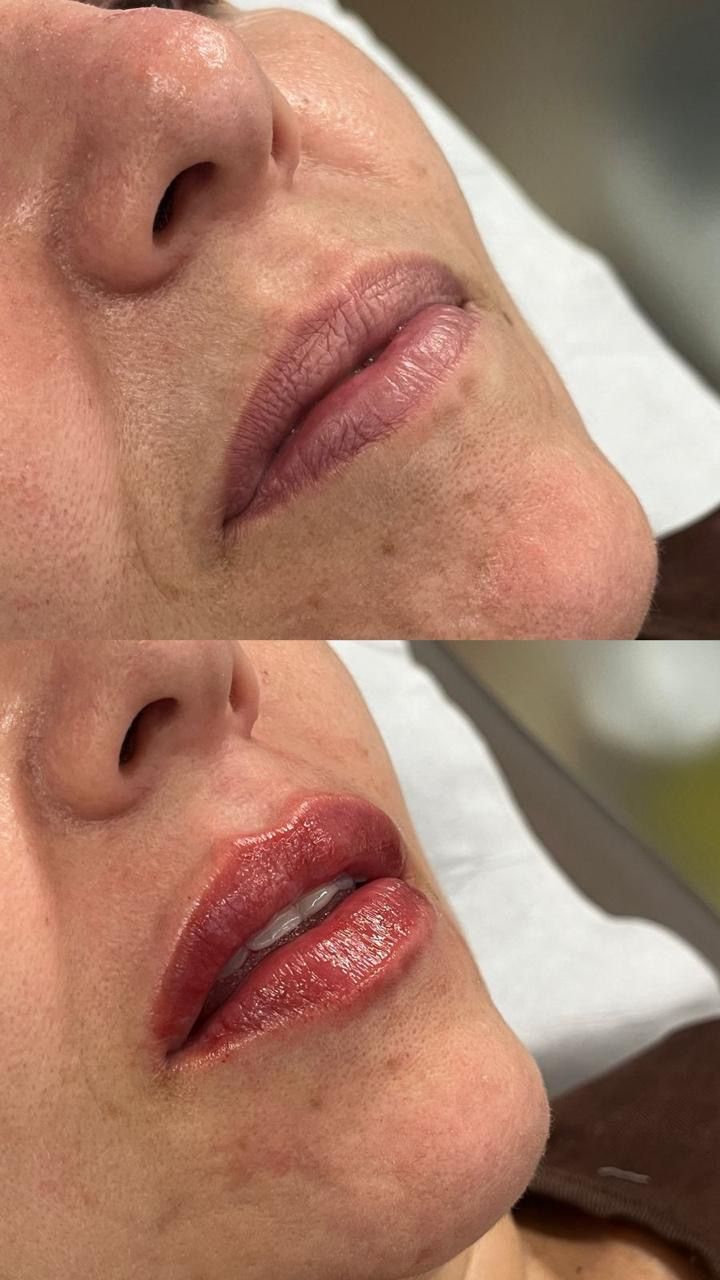 Preenchimento labial — Dra. Fernanda Rabelo