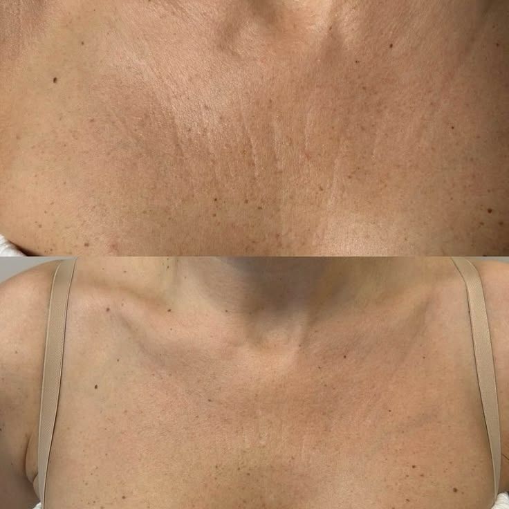 Rejuvenescimento de colo — Dra. Fernanda Rabelo