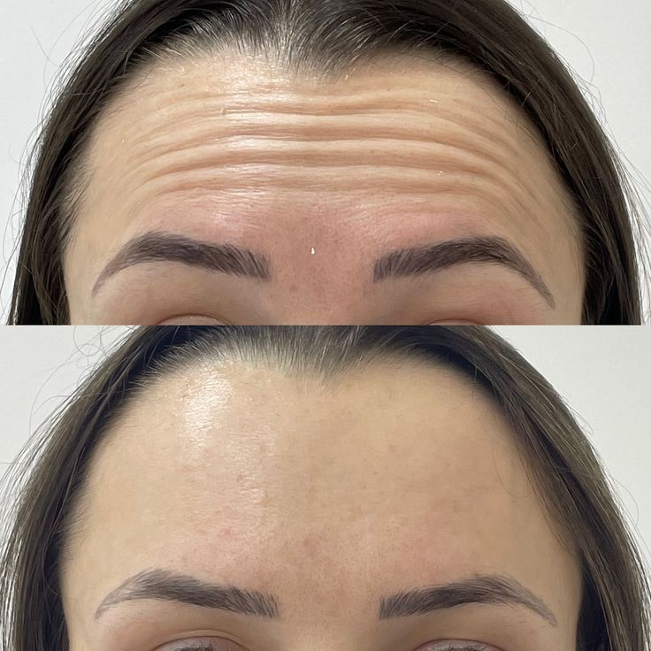 Botox — Dra. Fernanda Rabelo