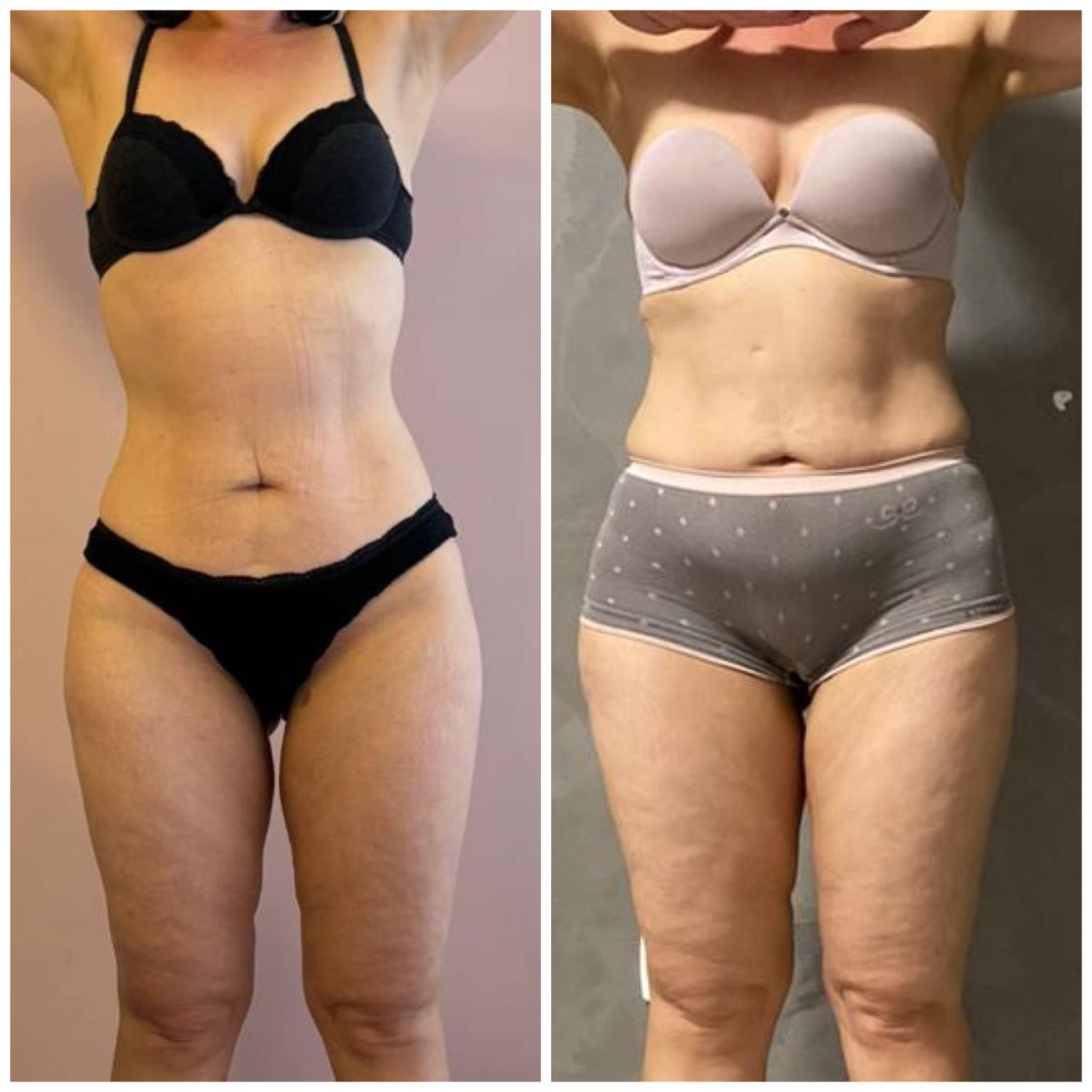 Lipen — tratamento de lipedema — Dra. Fernanda Rabelo