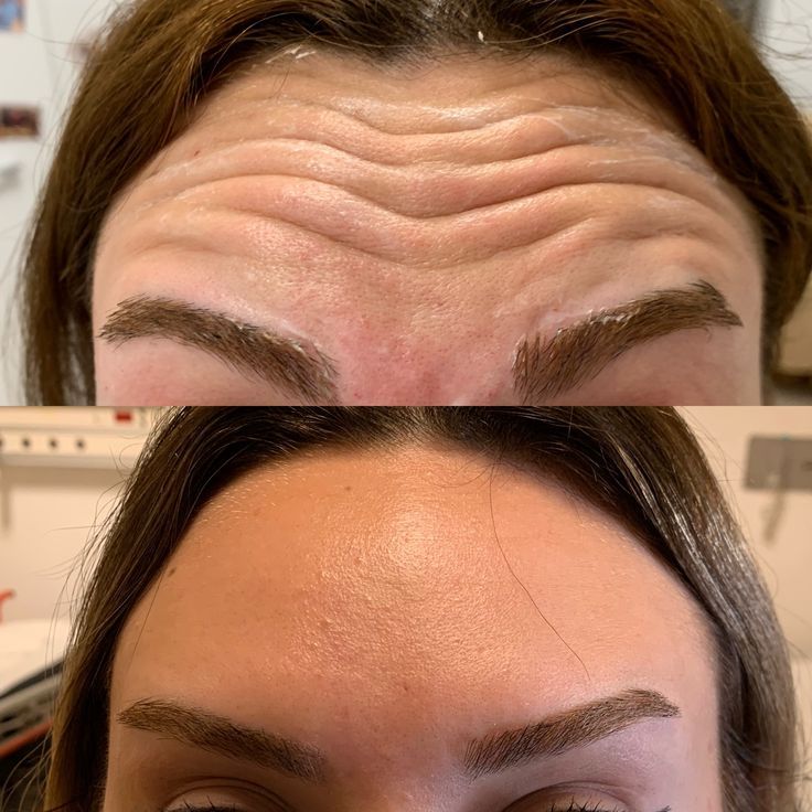 Botox — Dra. Fernanda Rabelo