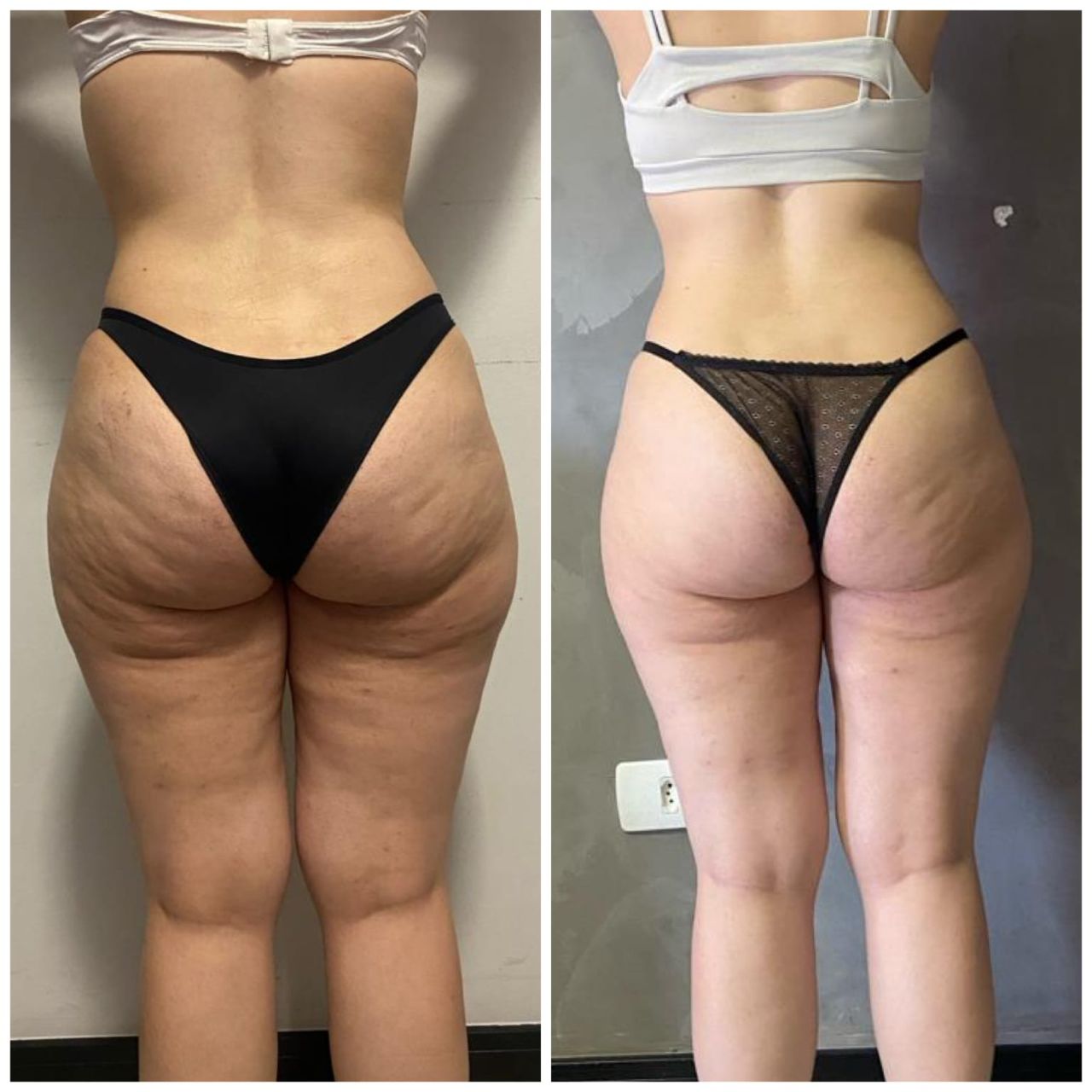 Tratamento de celulite — Dra. Fernanda Rabelo