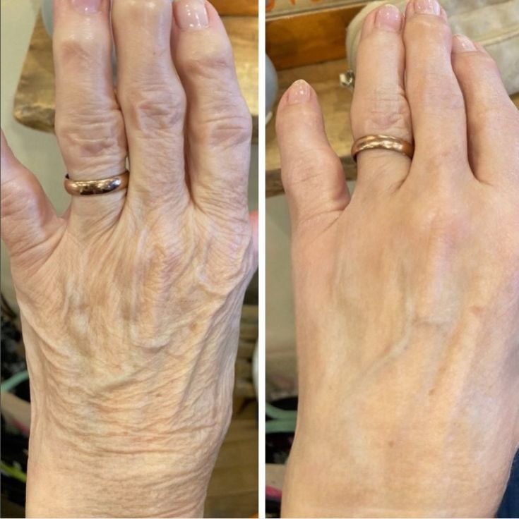 Rejuvenescimento de mãos — Dra. Fernanda Rabelo