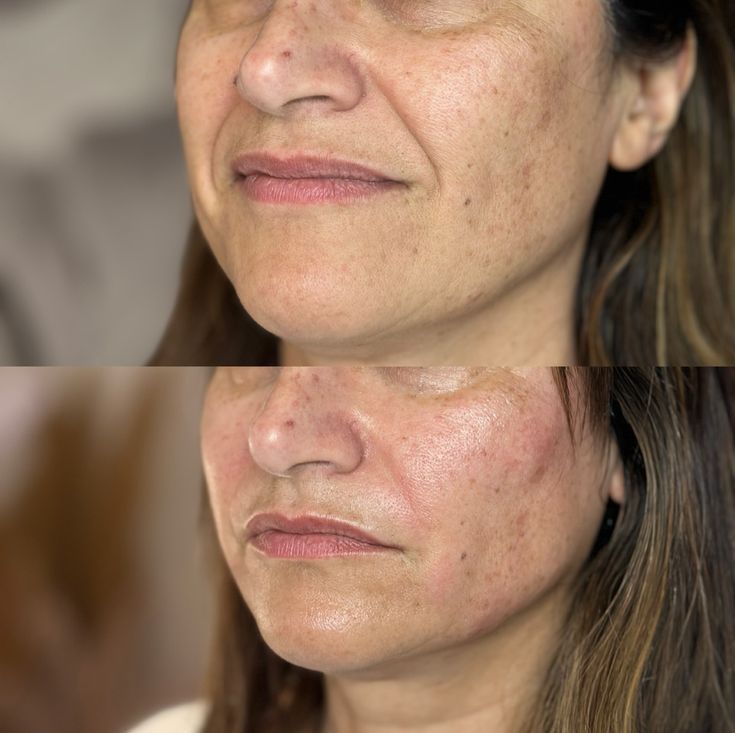 Bioestimulador — Dra. Fernanda Rabelo