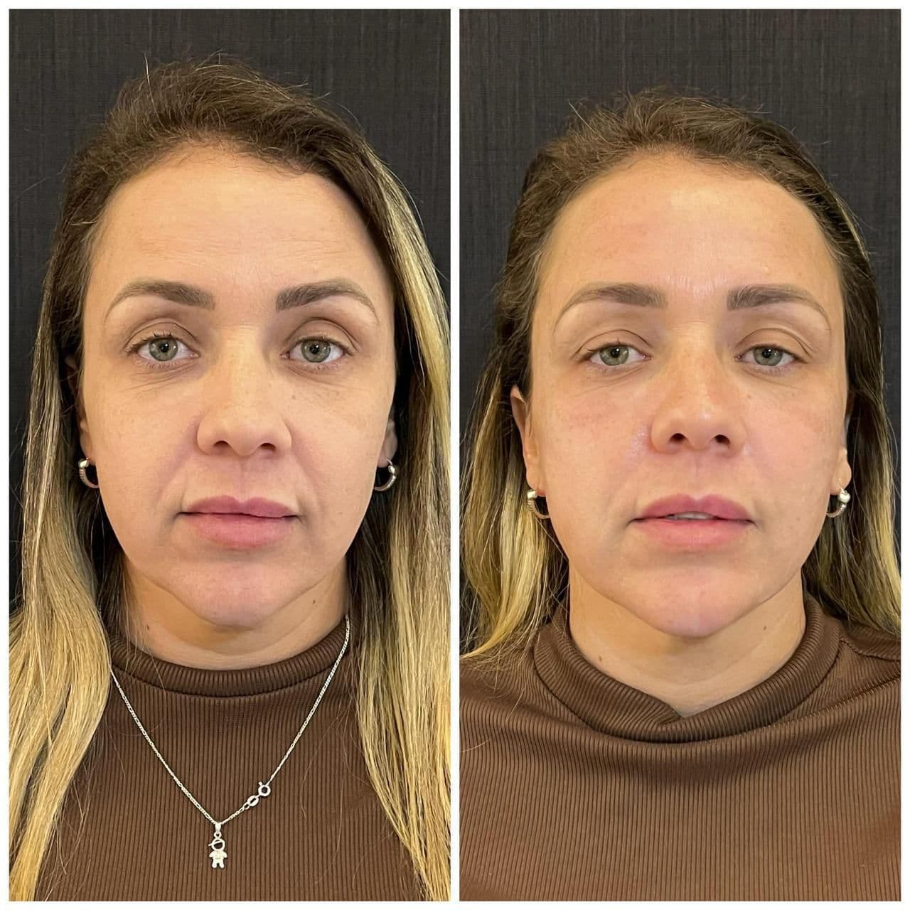 Ultrassom microfocado facial para lifting sem cirurgia na Clínica Fernanda Rabelo em Goiânia