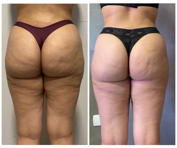 Tratamento para celulite com resultados visíveis em clínica de estética em Goiânia