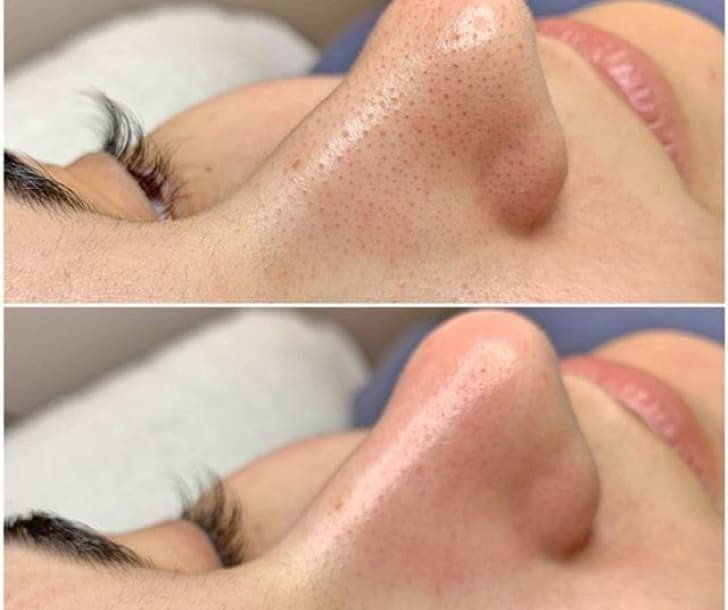 Limpeza de pele profissional em clínica de estética em Goiânia