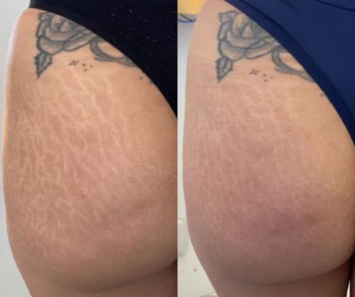 Striort tratamento de estrias na Clínica Fernanda Rabelo em Goiânia